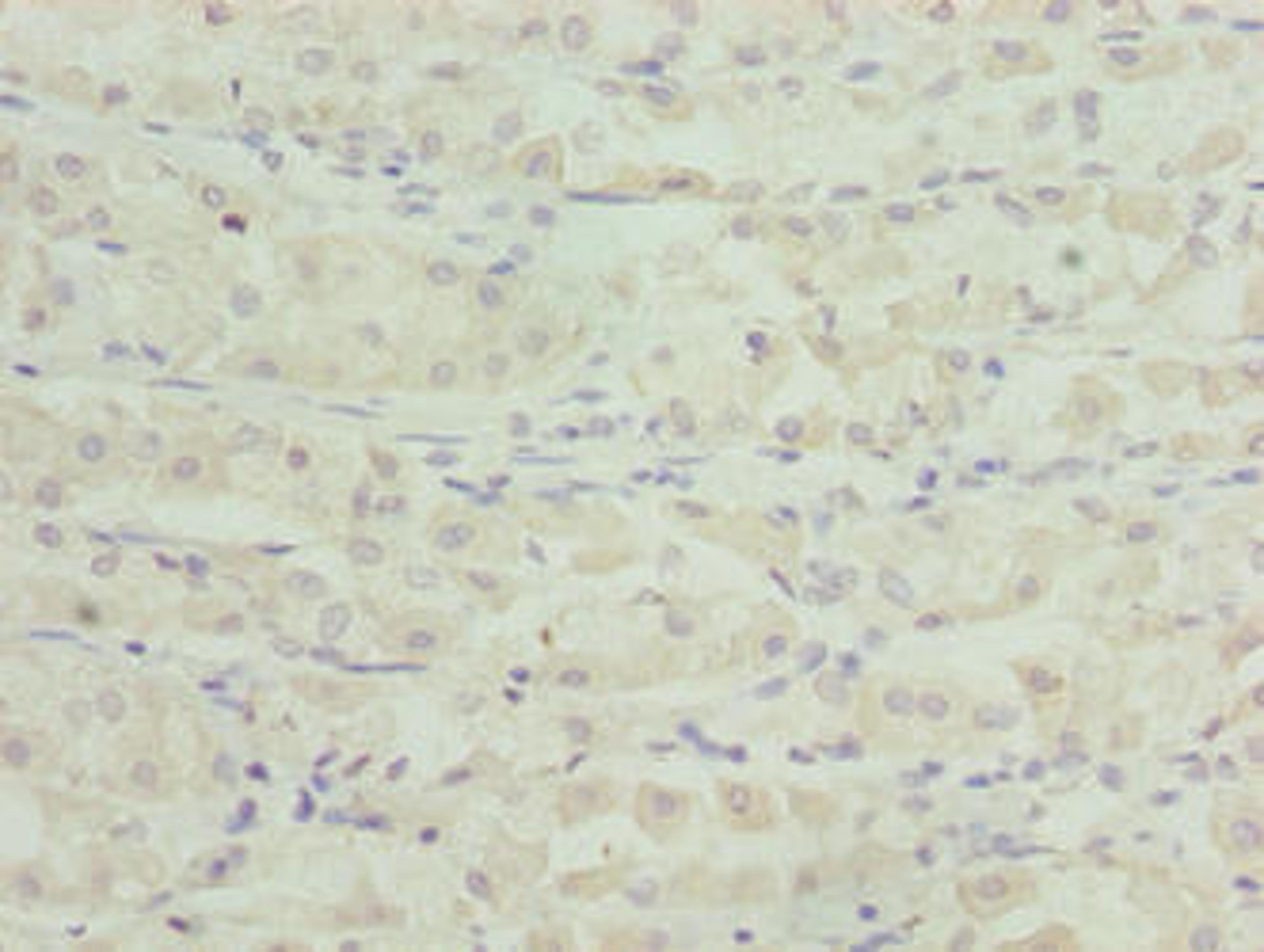 Immunohistochemistry of paraffin-embedded human gastric cancer using CSB-PA768209LA01HU at dilution of 1:100