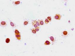Immunocytochemistry analysis of MCF-7 cells using CSB-PA010380PA33acHU at dilution of 1:100