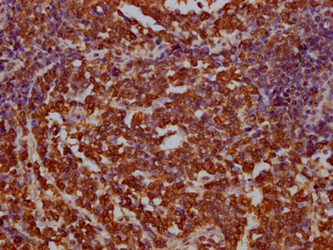 IHC image of CSB-PA002531LA01HU diluted at 1:100 and staining in paraffin-embedded human lung cancer performed on a Leica BondTM system. After dewaxing and hydration, antigen retrieval was mediated by high pressure in a citrate buffer (pH 6.0). Section was blocked with 10% normal goat serum 30min at RT. Then primary antibody (1% BSA) was incubated at 4°C overnight. The primary is detected by a Goat anti-rabbit IgG labeled by HRP and visualized using 0.05% DAB.