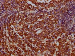 IHC image of CSB-PA002531LA01HU diluted at 1:100 and staining in paraffin-embedded human lung cancer performed on a Leica BondTM system. After dewaxing and hydration, antigen retrieval was mediated by high pressure in a citrate buffer (pH 6.0). Section was blocked with 10% normal goat serum 30min at RT. Then primary antibody (1% BSA) was incubated at 4°C overnight. The primary is detected by a Goat anti-rabbit IgG labeled by HRP and visualized using 0.05% DAB.
