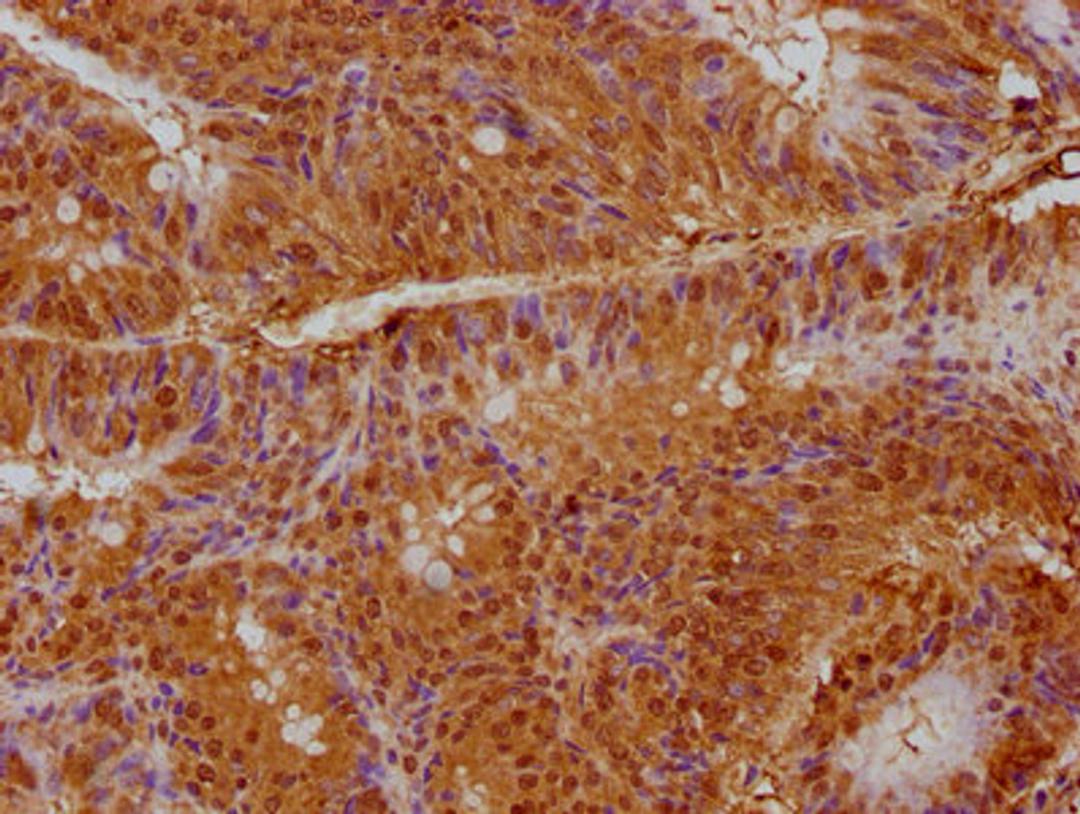 IHC image of CSB-PA018424LA01HU diluted at 1:200 and staining in paraffin-embedded human colon cancer performed on a Leica BondTM system. After dewaxing and hydration, antigen retrieval was mediated by high pressure in a citrate buffer (pH 6.0). Section was blocked with 10% normal goat serum 30min at RT. Then primary antibody (1% BSA) was incubated at 4&deg;C overnight. The primary is detected by a biotinylated secondary antibody and visualized using an HRP conjugated SP system.