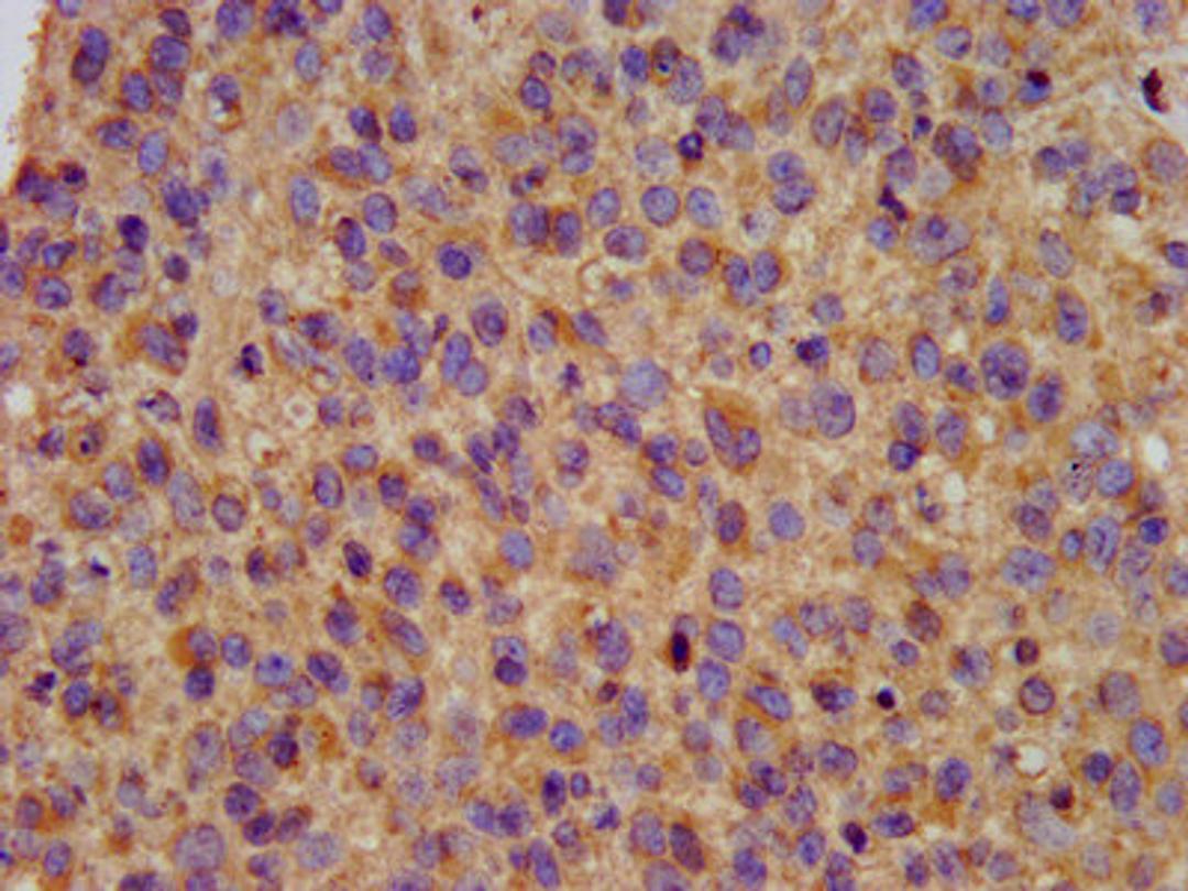 IHC image of CSB-PA22569A0Rb diluted at 1:200 and staining in paraffin-embedded human glioma performed on a Leica BondTM system. After dewaxing and hydration, antigen retrieval was mediated by high pressure in a citrate buffer (pH 6.0). Section was blocked with 10% normal goat serum 30min at RT. Then primary antibody (1% BSA) was incubated at 4&deg;C overnight. The primary is detected by a biotinylated secondary antibody and visualized using an HRP conjugated SP system.