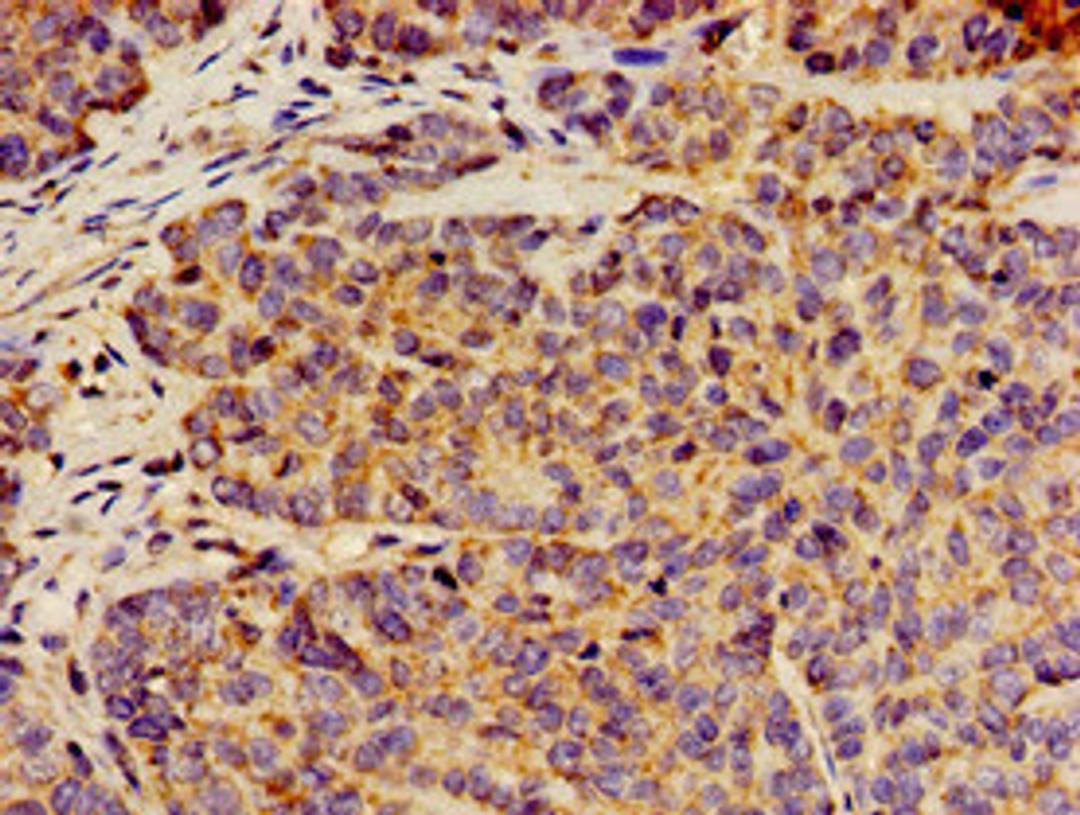 Immunohistochemistry of paraffin-embedded human ovarian cancer using CSB-PA804805LA01HU at dilution of 1:100