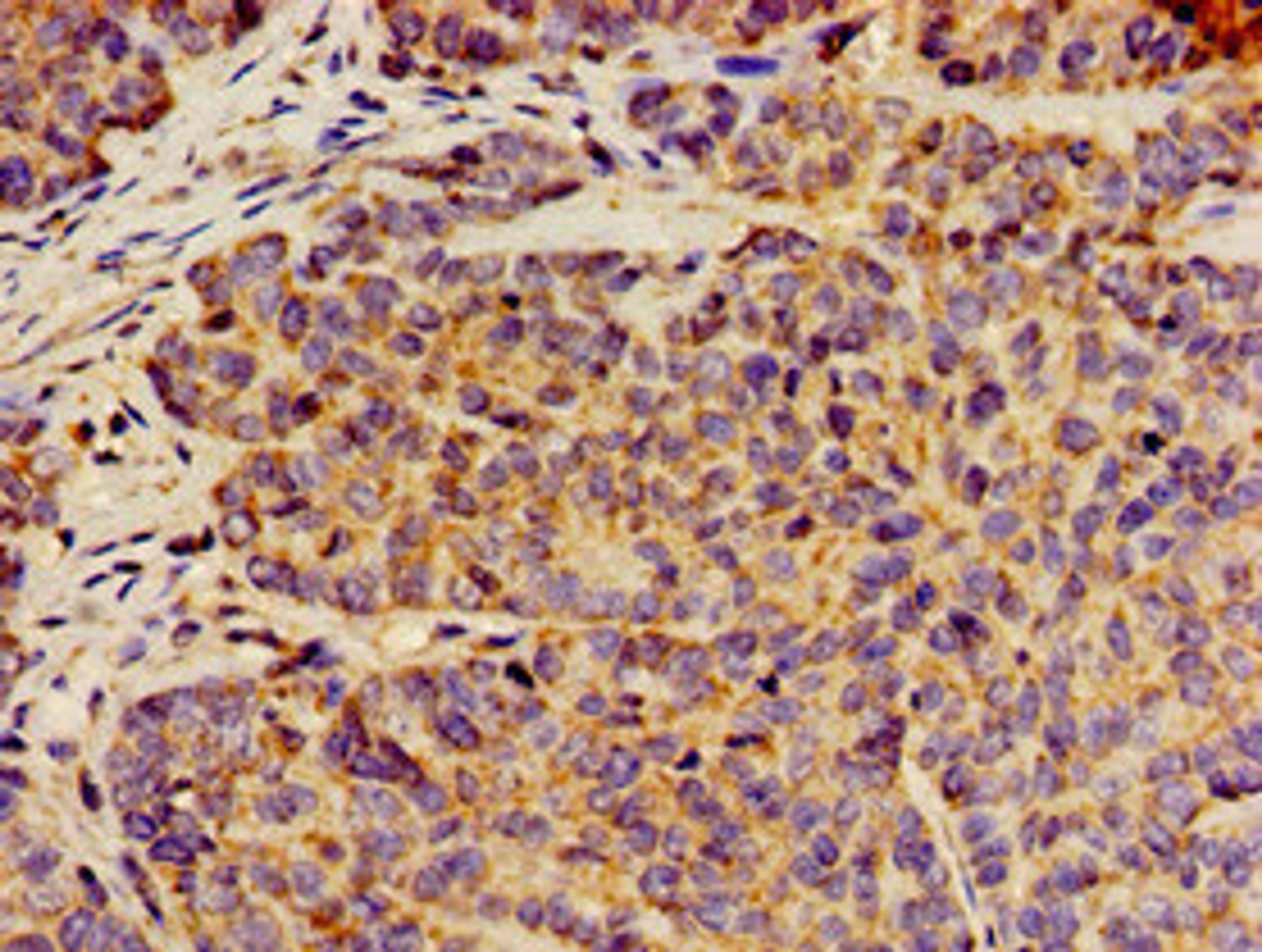 Immunohistochemistry of paraffin-embedded human ovarian cancer using CSB-PA804805LA01HU at dilution of 1:100