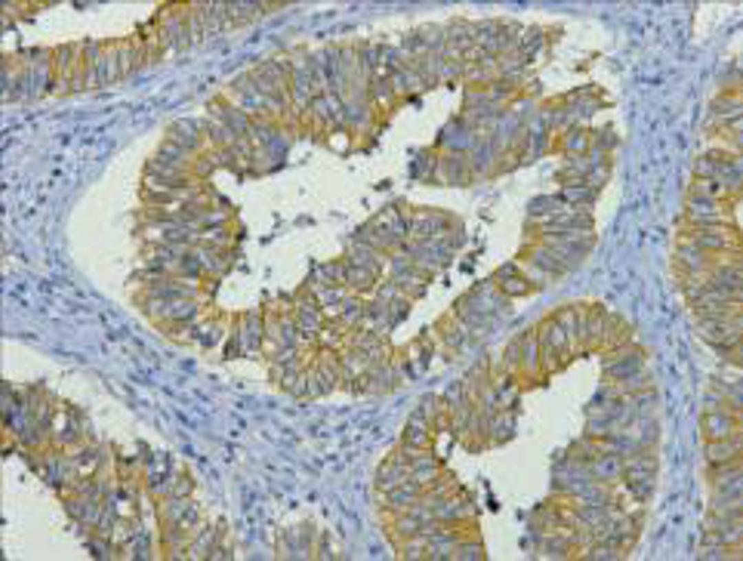 IHC staining of human colon cancer tissue, diluted at 1:200.
