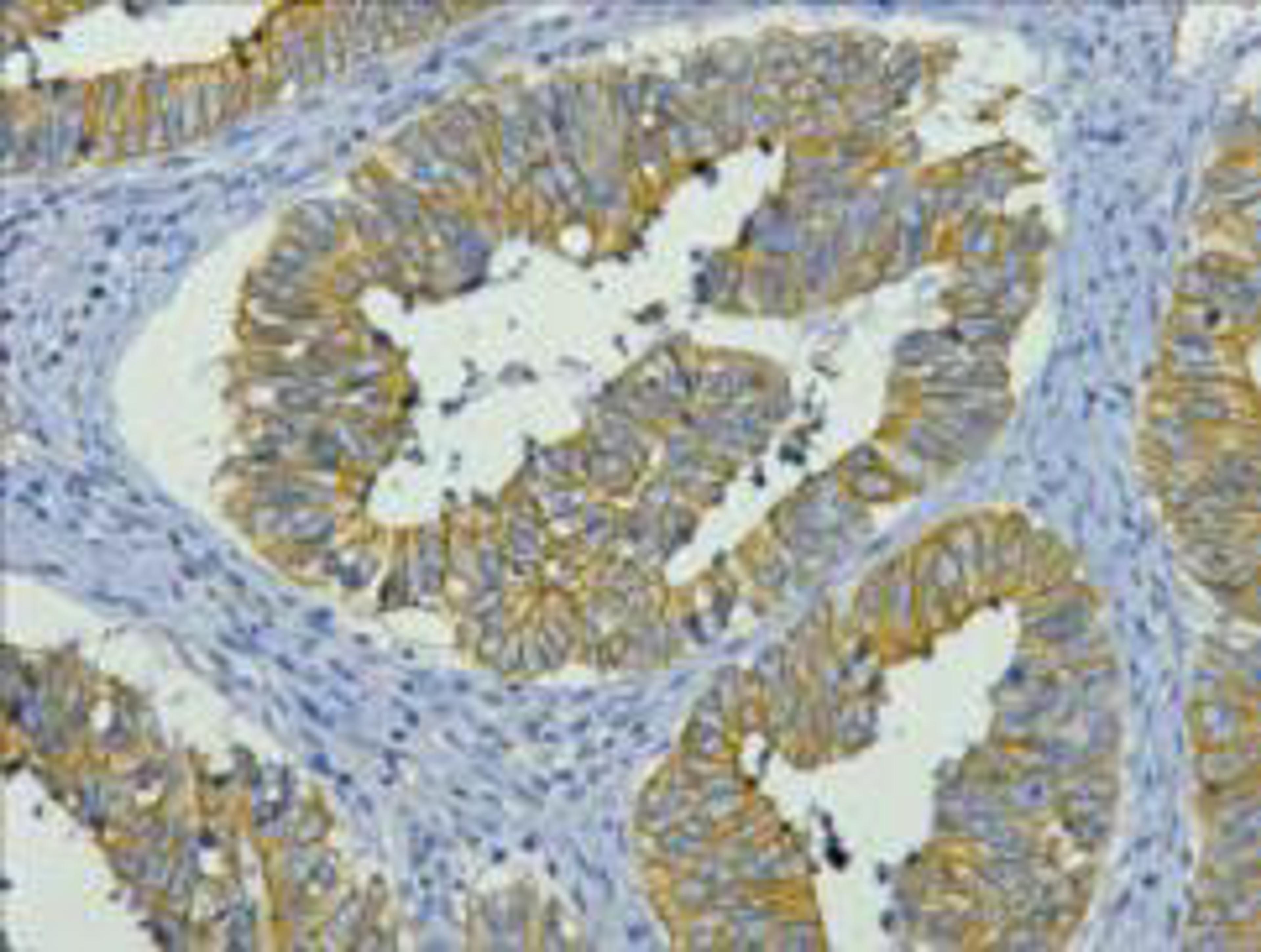 IHC staining of human colon cancer tissue, diluted at 1:200.