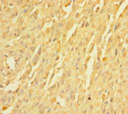 Immunohistochemistry of paraffin-embedded human melanoma using CSB-PA03899A0Rb at dilution of 1:100