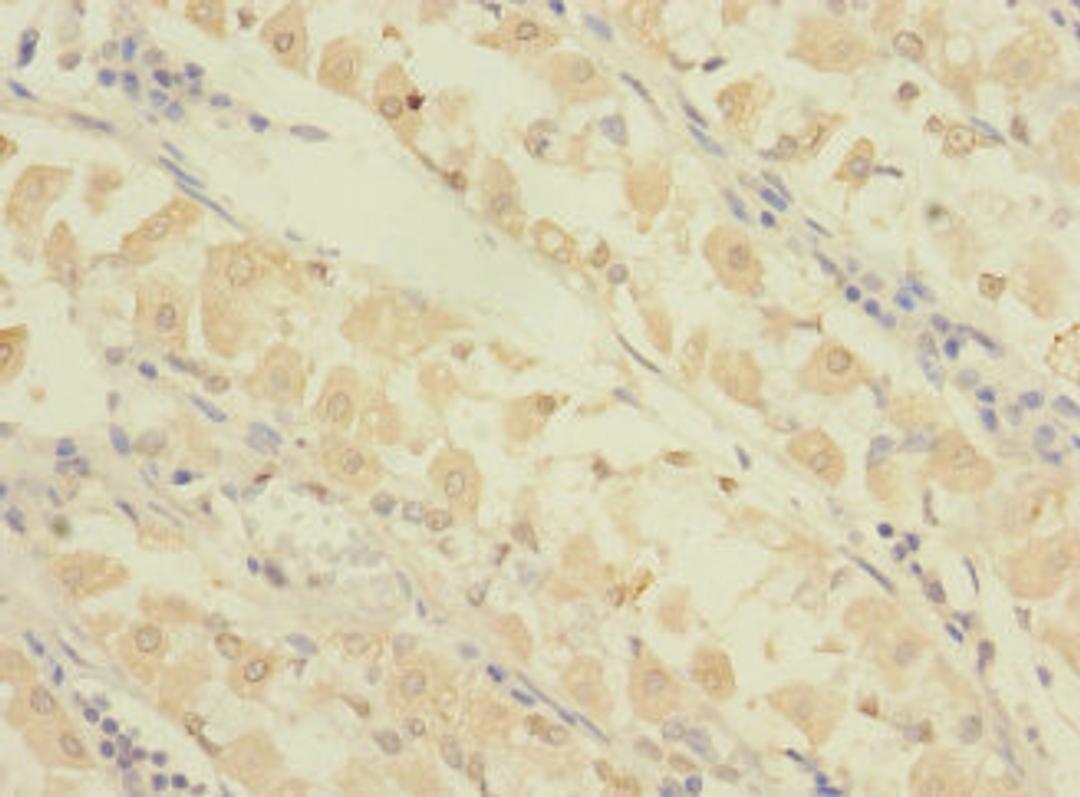 Immunohistochemistry of paraffin-embedded human gastric cancer using CSB-PA662055LA01HU at dilution of 1:100