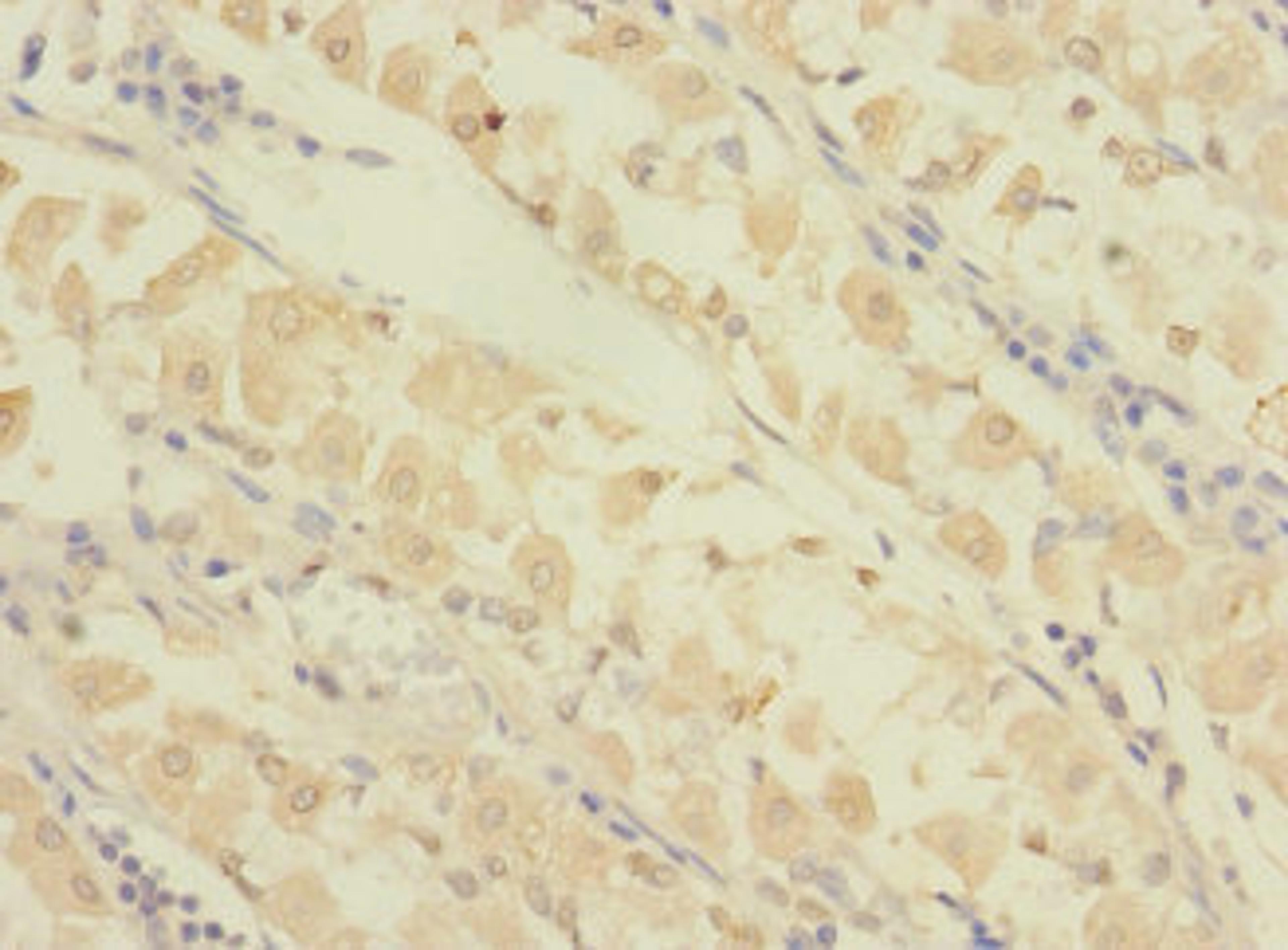 Immunohistochemistry of paraffin-embedded human gastric cancer using CSB-PA662055LA01HU at dilution of 1:100