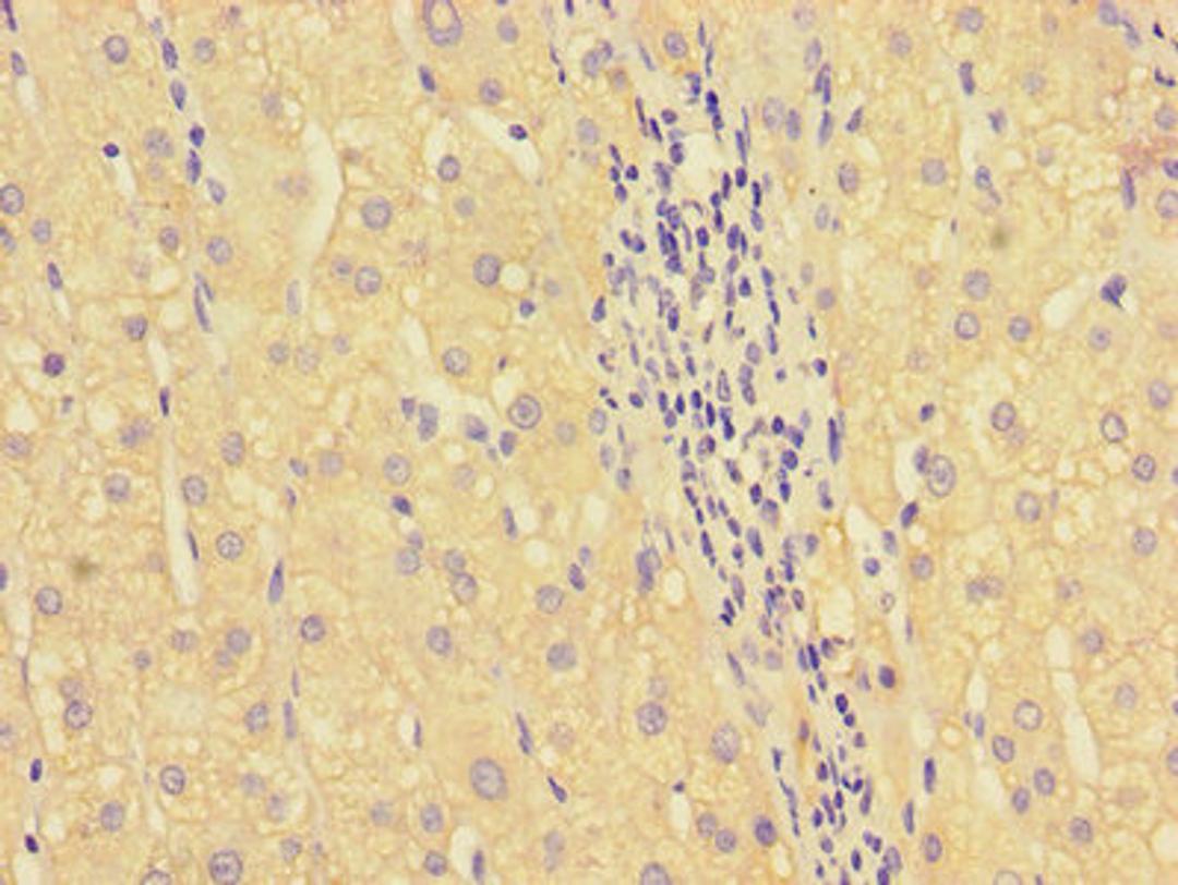 Immunohistochemistry of paraffin-embedded human liver cancer using CSB-PA010652LA01HU at dilution of 1:100