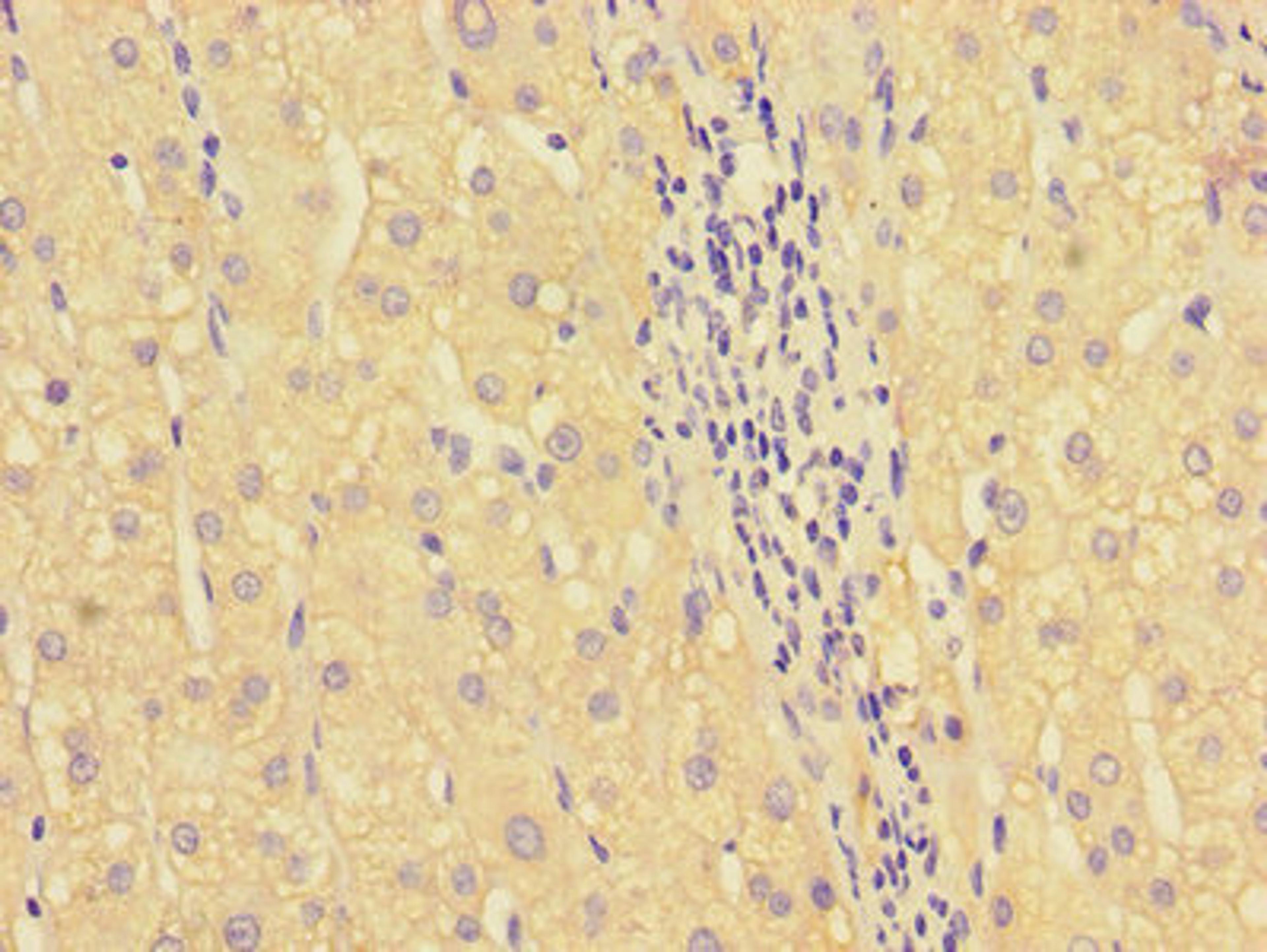Immunohistochemistry of paraffin-embedded human liver cancer using CSB-PA010652LA01HU at dilution of 1:100