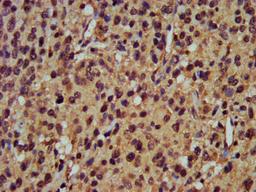 IHC image of CSB-PA018365LA01HU diluted at 1:400 and staining in paraffin-embedded human glioma performed on a Leica BondTM system. After dewaxing and hydration, antigen retrieval was mediated by high pressure in a citrate buffer (pH 6.0). Section was blocked with 10% normal goat serum 30min at RT. Then primary antibody (1% BSA) was incubated at 4&deg;C overnight. The primary is detected by a biotinylated secondary antibody and visualized using an HRP conjugated SP system.