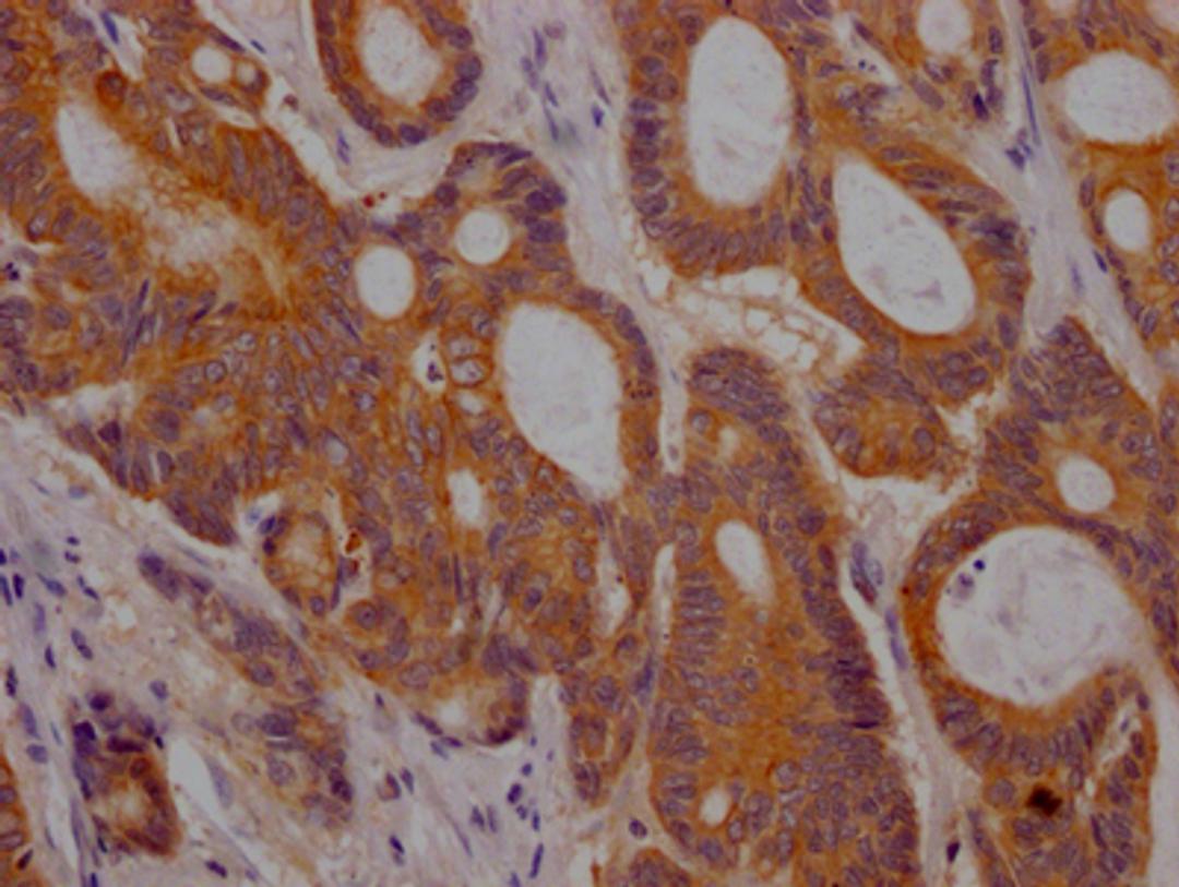 IHC image of CSB-RA280380A0HU diluted at 1:100 and staining in paraffin-embedded human colon cancer performed on a Leica BondTM system. After dewaxing and hydration, antigen retrieval was mediated by high pressure in a citrate buffer (pH 6.0). Section was blocked with 10% normal goat serum 30min at RT. Then primary antibody (1% BSA) was incubated at 4℃ overnight. The primary is detected by a Goat anti-rabbit IgG polymer labeled by HRP and visualized using 0.05% DAB.