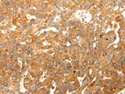 The image on the left is immunohistochemistry of paraffin-embedded Human breast cancer tissue using CSB-PA445743(CAPN1 Antibody) at dilution 1/20, on the right is treated with fusion protein. (Original magnification: ×200)