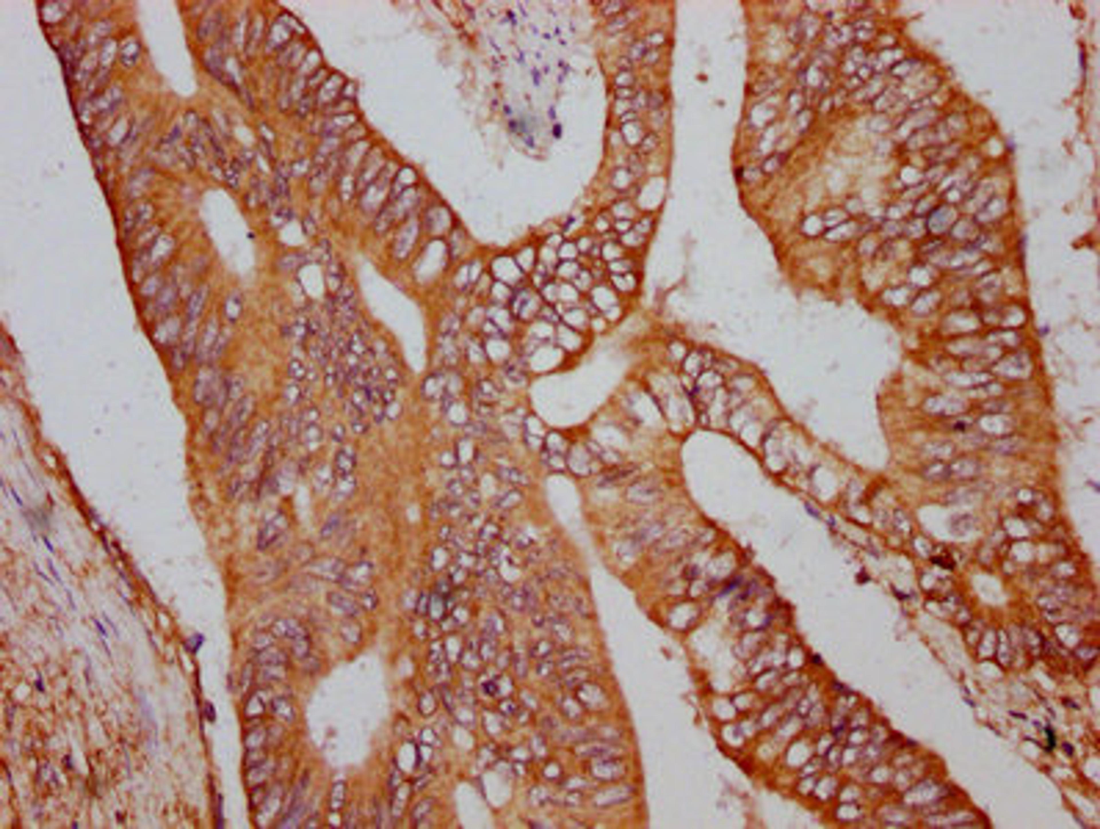 IHC image of CSB-PA757959LA01HU diluted at 1:600 and staining in paraffin-embedded human colon cancer performed on a Leica BondTM system. After dewaxing and hydration, antigen retrieval was mediated by high pressure in a citrate buffer (pH 6.0). Section was blocked with 10% normal goat serum 30min at RT. Then primary antibody (1% BSA) was incubated at 4&deg;C overnight. The primary is detected by a biotinylated secondary antibody and visualized using an HRP conjugated SP system.