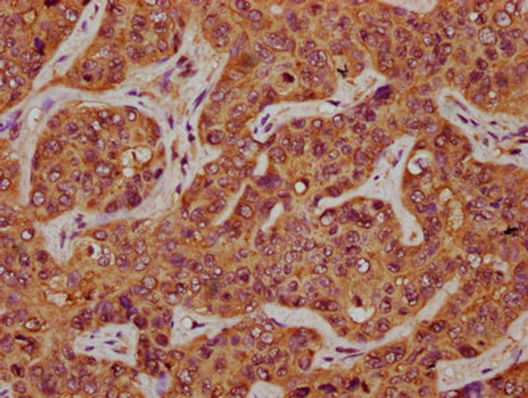 IHC image of CSB-PA22579A0Rb diluted at 1:200 and staining in paraffin-embedded human liver cancer performed on a Leica BondTM system. After dewaxing and hydration, antigen retrieval was mediated by high pressure in a citrate buffer (pH 6.0). Section was blocked with 10% normal goat serum 30min at RT. Then primary antibody (1% BSA) was incubated at 4&deg;C overnight. The primary is detected by a biotinylated secondary antibody and visualized using an HRP conjugated SP system.
