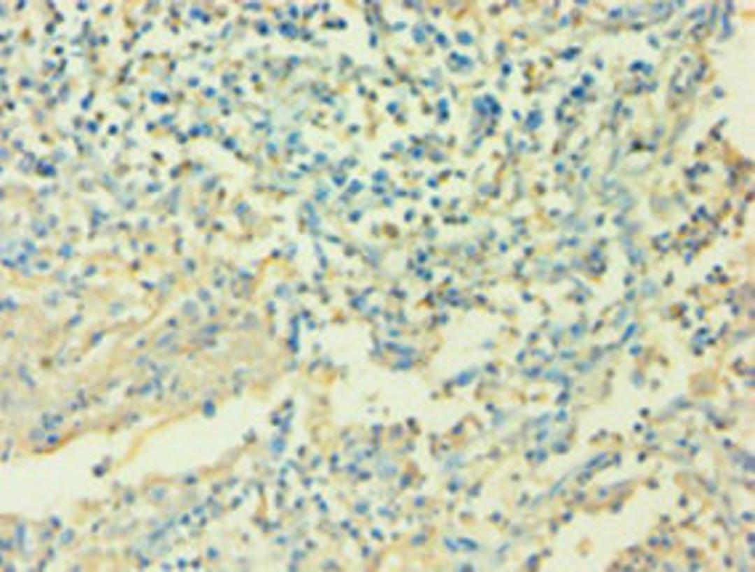 Immunohistochemistry of paraffin-embedded human cervical cancer using CSB-PA06757A0Rb at dilution of 1:100