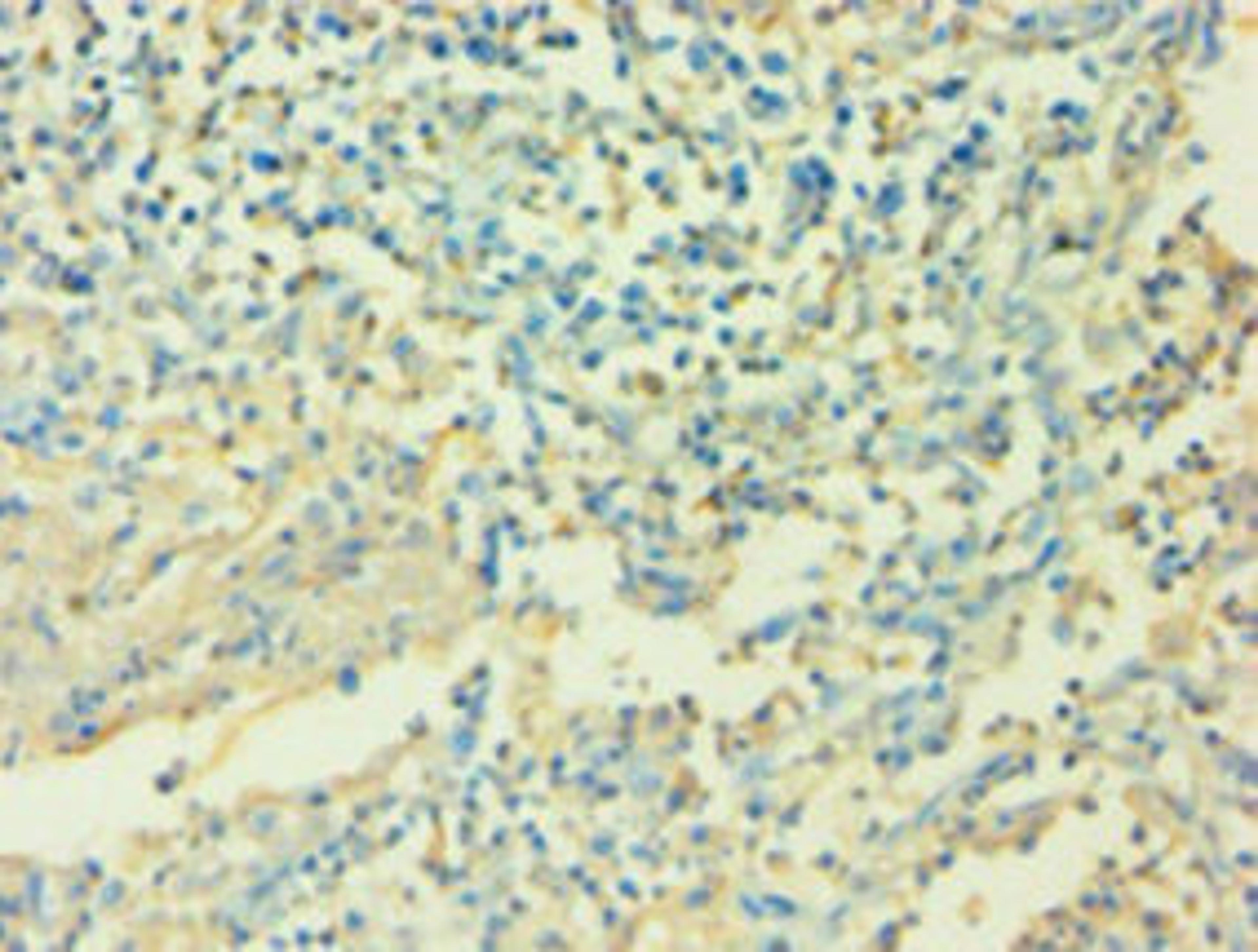 Immunohistochemistry of paraffin-embedded human cervical cancer using CSB-PA06757A0Rb at dilution of 1:100