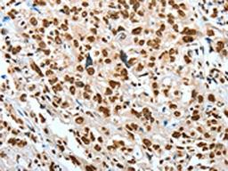 The image on the left is immunohistochemistry of paraffin-embedded Human esophagus cancer tissue using CSB-PA956646(BNIP1 Antibody) at dilution 1/60, on the right is treated with fusion protein. (Original magnification: ×200)
