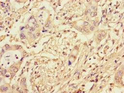 Immunohistochemistry of paraffin-embedded human pancreatic cancer using CSB-PA875721LA01HU at dilution of 1:100