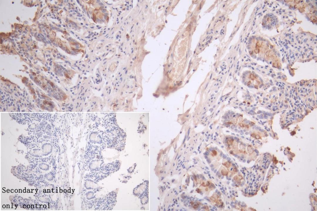 Immunohistochemistry of paraffin-embedded human colon cancer using CSB-PA846610LA01HU at dilution of 1:100