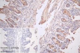 Immunohistochemistry of paraffin-embedded human colon cancer using CSB-PA846610LA01HU at dilution of 1:100