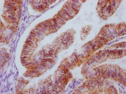 IHC image of CSB-MA963136 diluted at 1:100 and staining in paraffin-embedded human endometrial cancer performed on a Leica BondTM system. After dewaxing and hydration, antigen retrieval was mediated by high pressure in a citrate buffer (pH 6.0). Section was blocked with 10% normal goat serum 30min at RT. Then primary antibody (1% BSA) was incubated at 4°C overnight. The primary is detected by a Goat anti-mouse IgG polymer labeled by HRP and visualized using 0.05% DAB.
