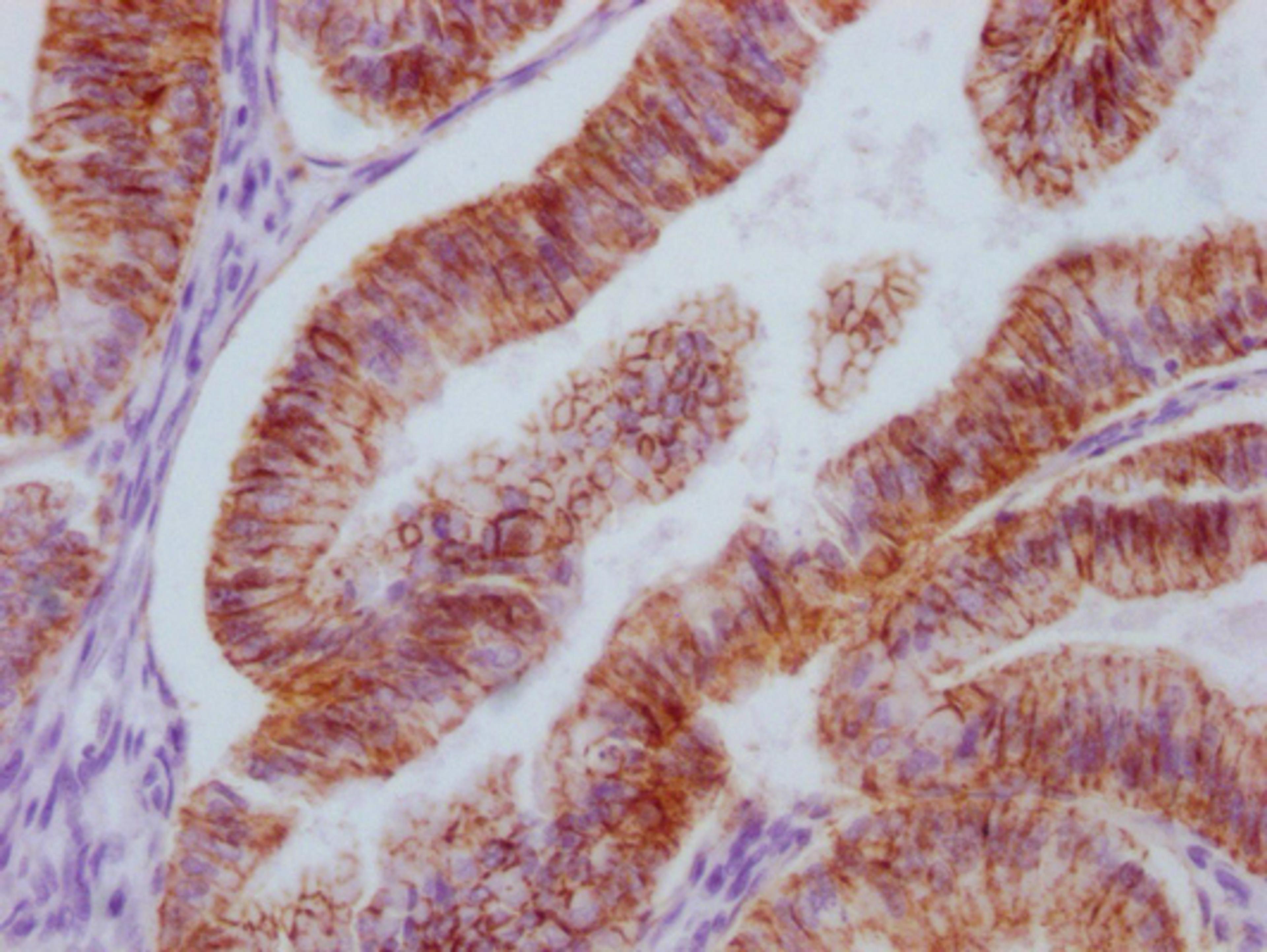 IHC image of CSB-MA963136 diluted at 1:100 and staining in paraffin-embedded human endometrial cancer performed on a Leica BondTM system. After dewaxing and hydration, antigen retrieval was mediated by high pressure in a citrate buffer (pH 6.0). Section was blocked with 10% normal goat serum 30min at RT. Then primary antibody (1% BSA) was incubated at 4°C overnight. The primary is detected by a Goat anti-mouse IgG polymer labeled by HRP and visualized using 0.05% DAB.