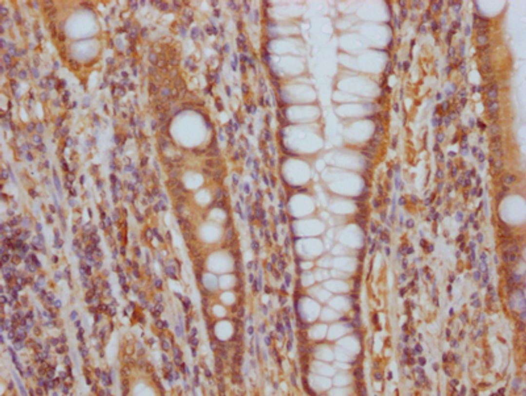IHC image of CSB-RA548303A0HU diluted at 1:100 and staining in paraffin-embedded human colon cancer performed on a Leica BondTM system. After dewaxing and hydration, antigen retrieval was mediated by high pressure in a citrate buffer (pH 6.0). Section was blocked with 10% normal goat serum 30min at RT. Then primary antibody (1% BSA) was incubated at 4℃ overnight. The primary is detected by a Goat anti-rabbit IgG polymer labeled by HRP and visualized using 0.05% DAB.