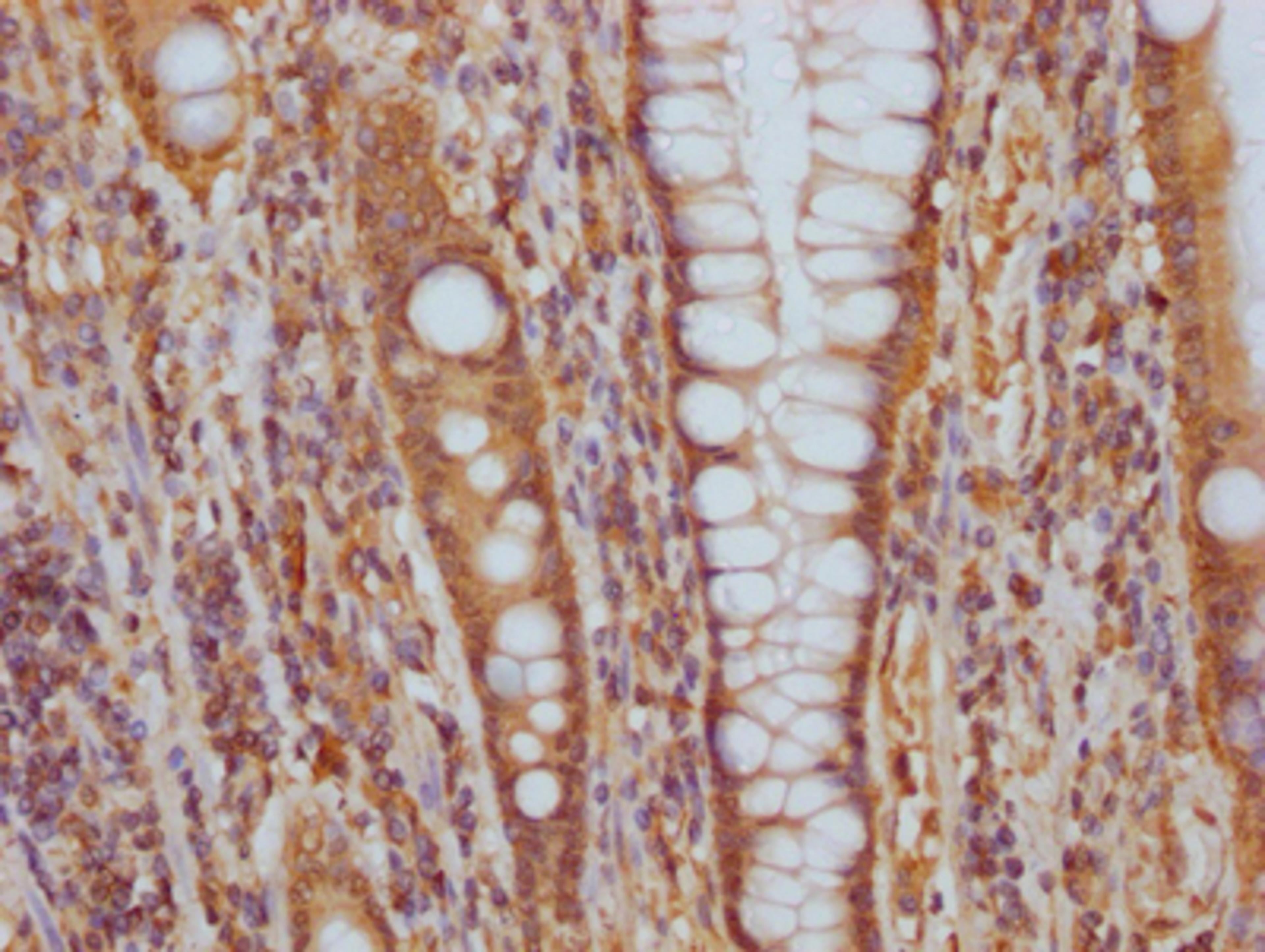 IHC image of CSB-RA548303A0HU diluted at 1:100 and staining in paraffin-embedded human colon cancer performed on a Leica BondTM system. After dewaxing and hydration, antigen retrieval was mediated by high pressure in a citrate buffer (pH 6.0). Section was blocked with 10% normal goat serum 30min at RT. Then primary antibody (1% BSA) was incubated at 4℃ overnight. The primary is detected by a Goat anti-rabbit IgG polymer labeled by HRP and visualized using 0.05% DAB.