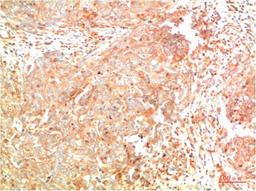 Immunohistochemical analysis of paraffin-embedded Human Breast Carcinoma Tissue using ATG7  Mouse mAb diluted at 1:200.