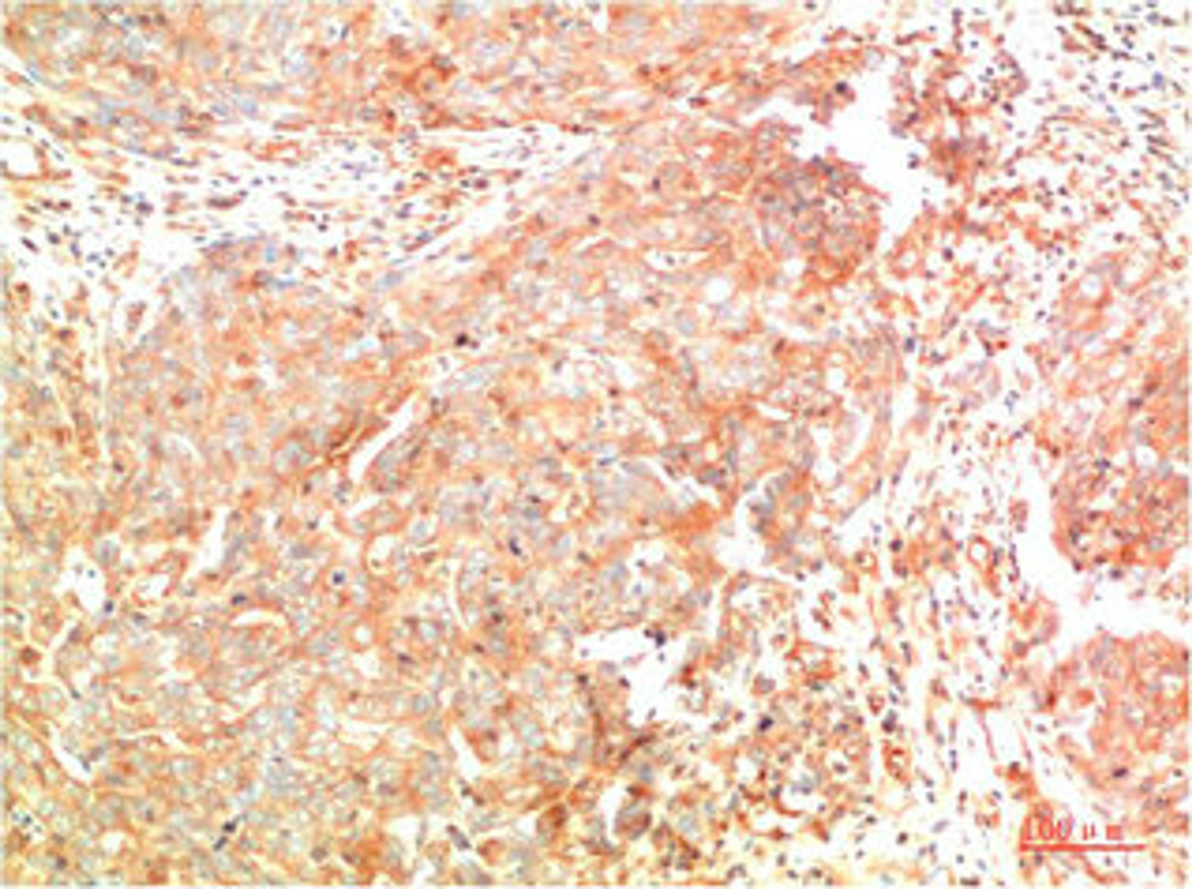 Immunohistochemical analysis of paraffin-embedded Human Breast Carcinoma Tissue using ATG7  Mouse mAb diluted at 1:200.