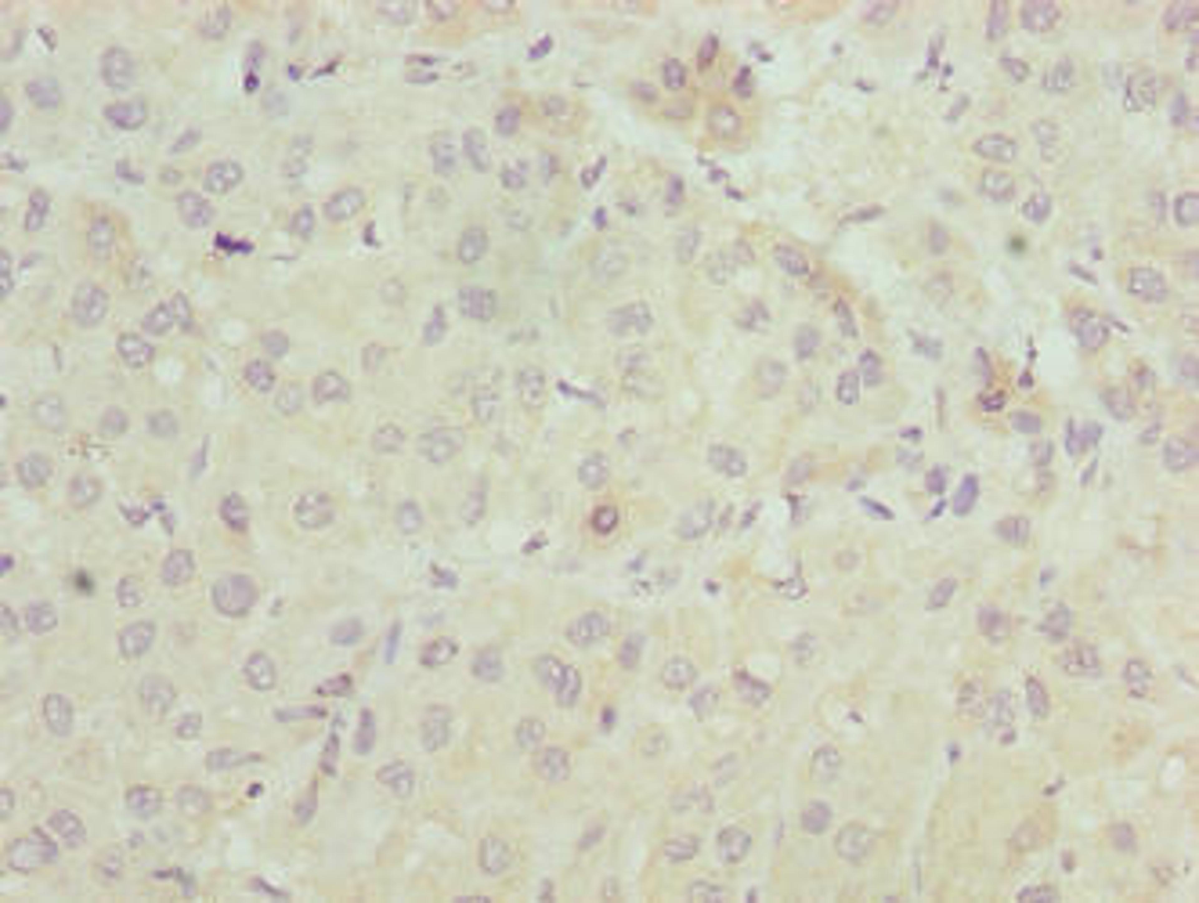 Immunohistochemistry of paraffin-embedded human liver cancer using CSB-PA889139LA01HU at dilution of 1:100