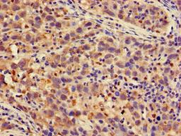 Immunohistochemistry of paraffin-embedded human pancreatic cancer using CSB-PA018869LA01HU at dilution of 1:100