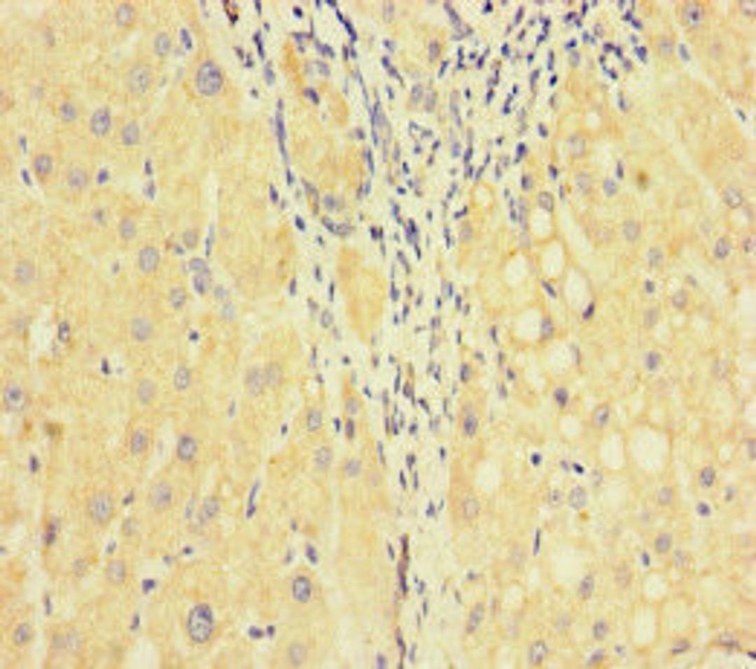 Immunohistochemistry of paraffin-embedded human liver cancer using CSB-PA007929HA01HU at dilution of 1:100