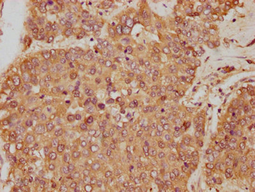 IHC image of CSB-PA009679HA01HU diluted at 1:250 and staining in paraffin-embedded human liver cancer performed on a Leica BondTM system. After dewaxing and hydration, antigen retrieval was mediated by high pressure in a citrate buffer (pH 6.0). Section was blocked with 10% normal goat serum 30min at RT. Then primary antibody (1% BSA) was incubated at 4&deg;C overnight. The primary is detected by a biotinylated secondary antibody and visualized using an HRP conjugated SP system.