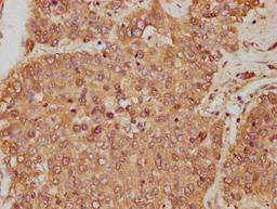 IHC image of CSB-PA009679HA01HU diluted at 1:250 and staining in paraffin-embedded human liver cancer performed on a Leica BondTM system. After dewaxing and hydration, antigen retrieval was mediated by high pressure in a citrate buffer (pH 6.0). Section was blocked with 10% normal goat serum 30min at RT. Then primary antibody (1% BSA) was incubated at 4&deg;C overnight. The primary is detected by a biotinylated secondary antibody and visualized using an HRP conjugated SP system.