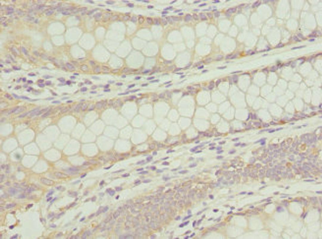 Immunohistochemistry of paraffin-embedded human colon cancer using CSB-PA892446DSR1HU at dilution of 1:100