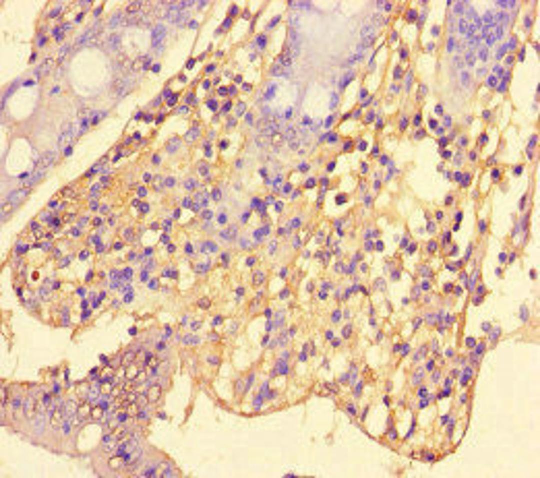 Immunohistochemistry of paraffin-embedded human colon cancer using CSB-PA20519A0Rb at dilution of 1:100