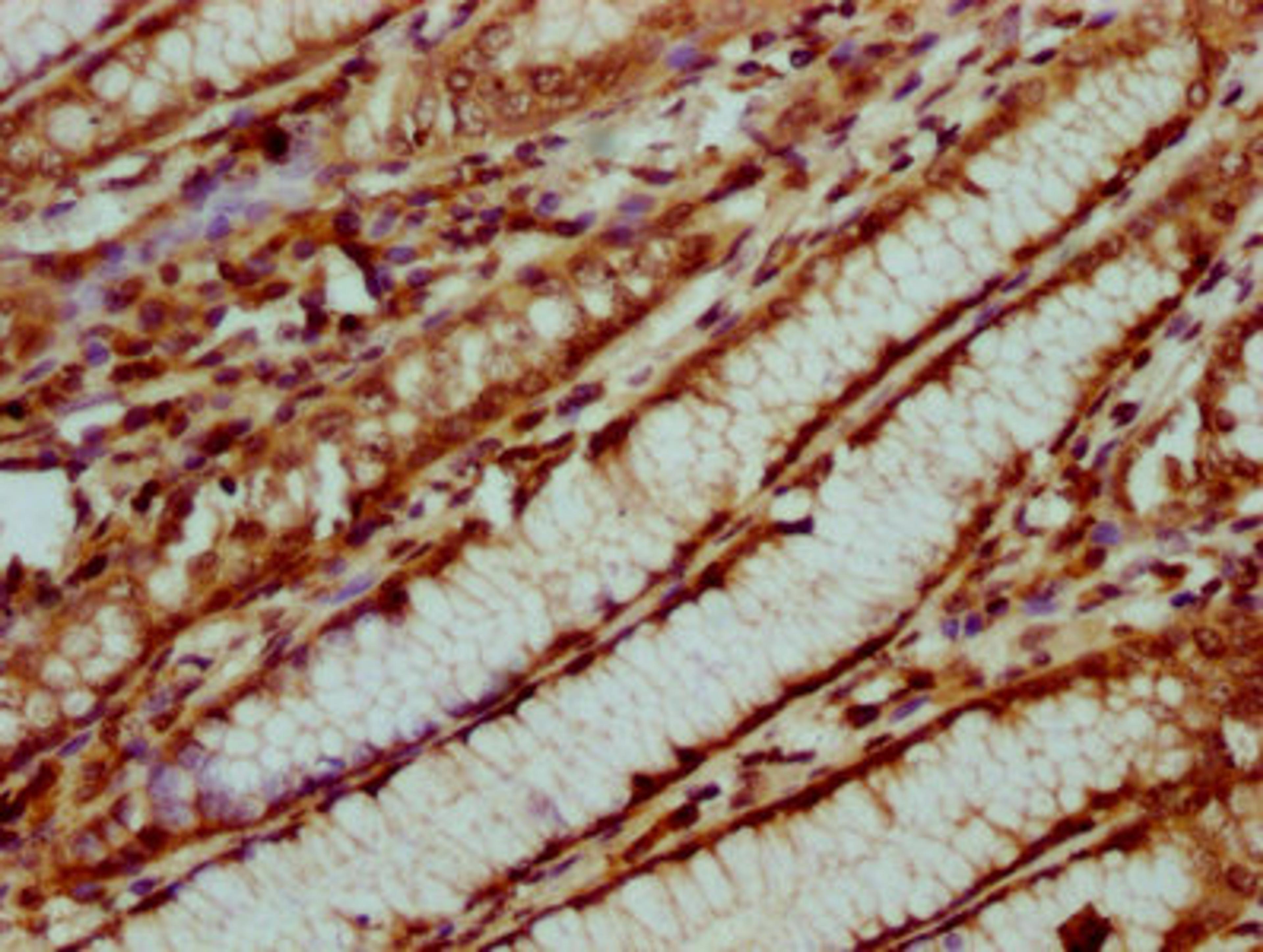 IHC image of CSB-PA010429OA31nsucHU diluted at 1:20 and staining in paraffin-embedded human gastric cancer performed on a Leica BondTM system. After dewaxing and hydration, antigen retrieval was mediated by high pressure in a citrate buffer (pH 6.0). Section was blocked with 10% normal goat serum 30min at RT. Then primary antibody (1% BSA) was incubated at 4&deg;C overnight. The primary is detected by a biotinylated secondary antibody and visualized using an HRP conjugated SP system.