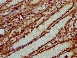 IHC image of CSB-PA010429OA31nsucHU diluted at 1:20 and staining in paraffin-embedded human gastric cancer performed on a Leica BondTM system. After dewaxing and hydration, antigen retrieval was mediated by high pressure in a citrate buffer (pH 6.0). Section was blocked with 10% normal goat serum 30min at RT. Then primary antibody (1% BSA) was incubated at 4°C overnight. The primary is detected by a biotinylated secondary antibody and visualized using an HRP conjugated SP system.