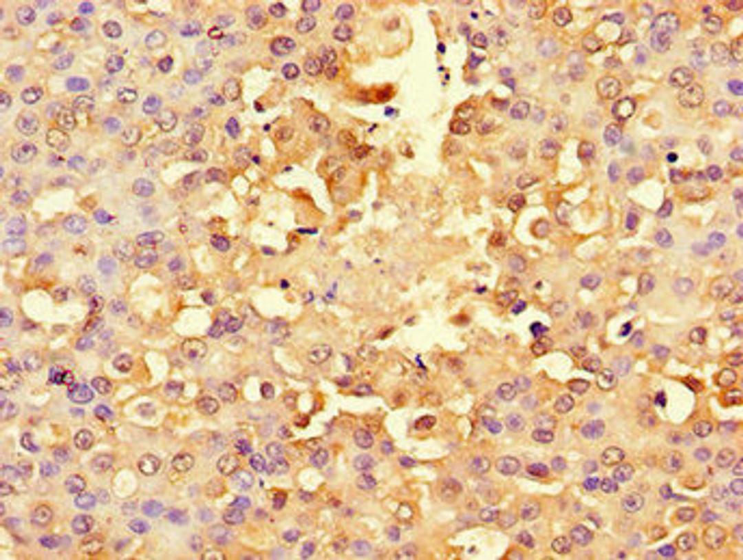 Immunohistochemistry of paraffin-embedded human breast cancer using CSB-PA020463LA01HU at dilution of 1:100