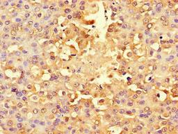 Immunohistochemistry of paraffin-embedded human breast cancer using CSB-PA020463LA01HU at dilution of 1:100