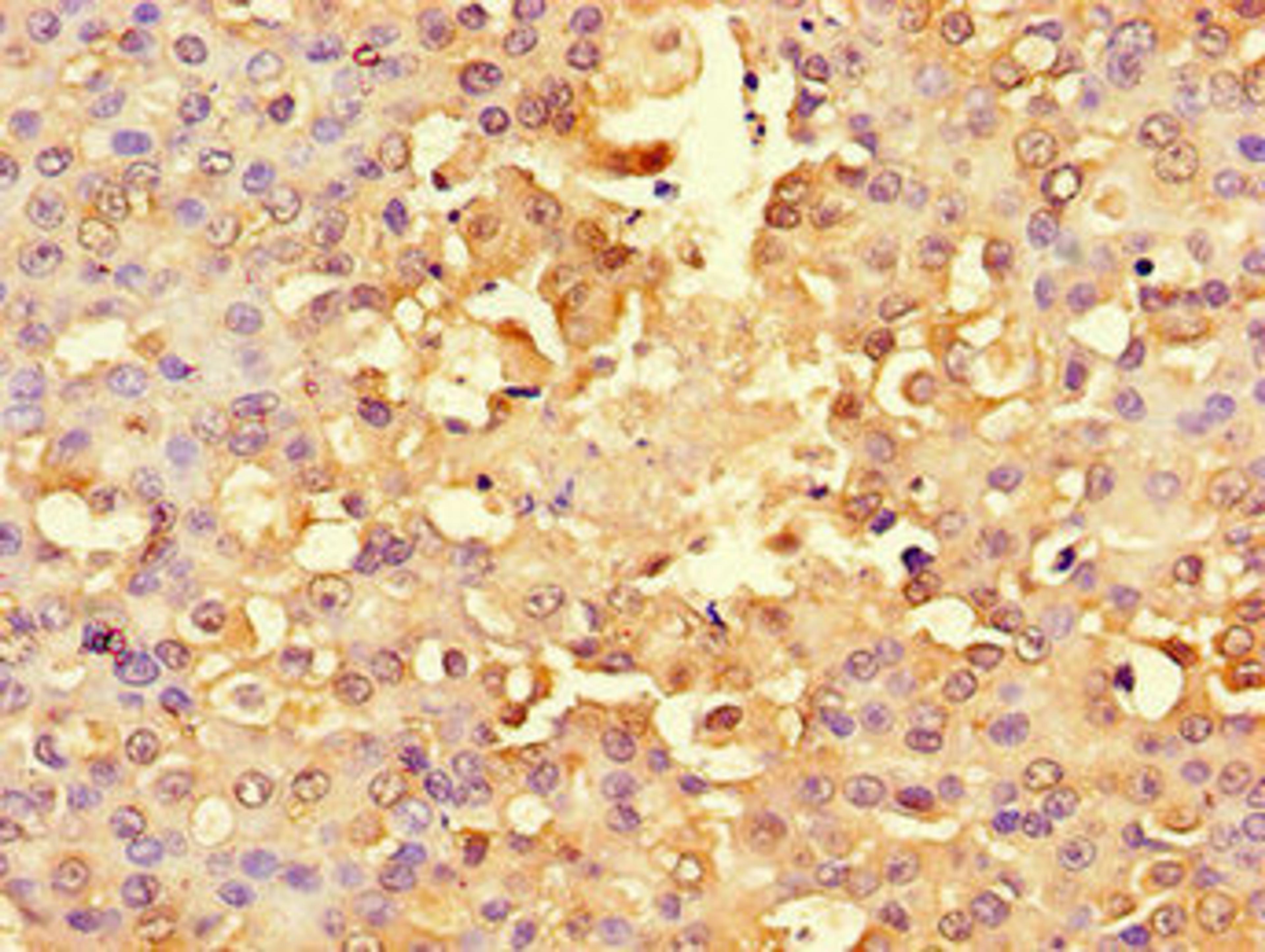 Immunohistochemistry of paraffin-embedded human breast cancer using CSB-PA020463LA01HU at dilution of 1:100