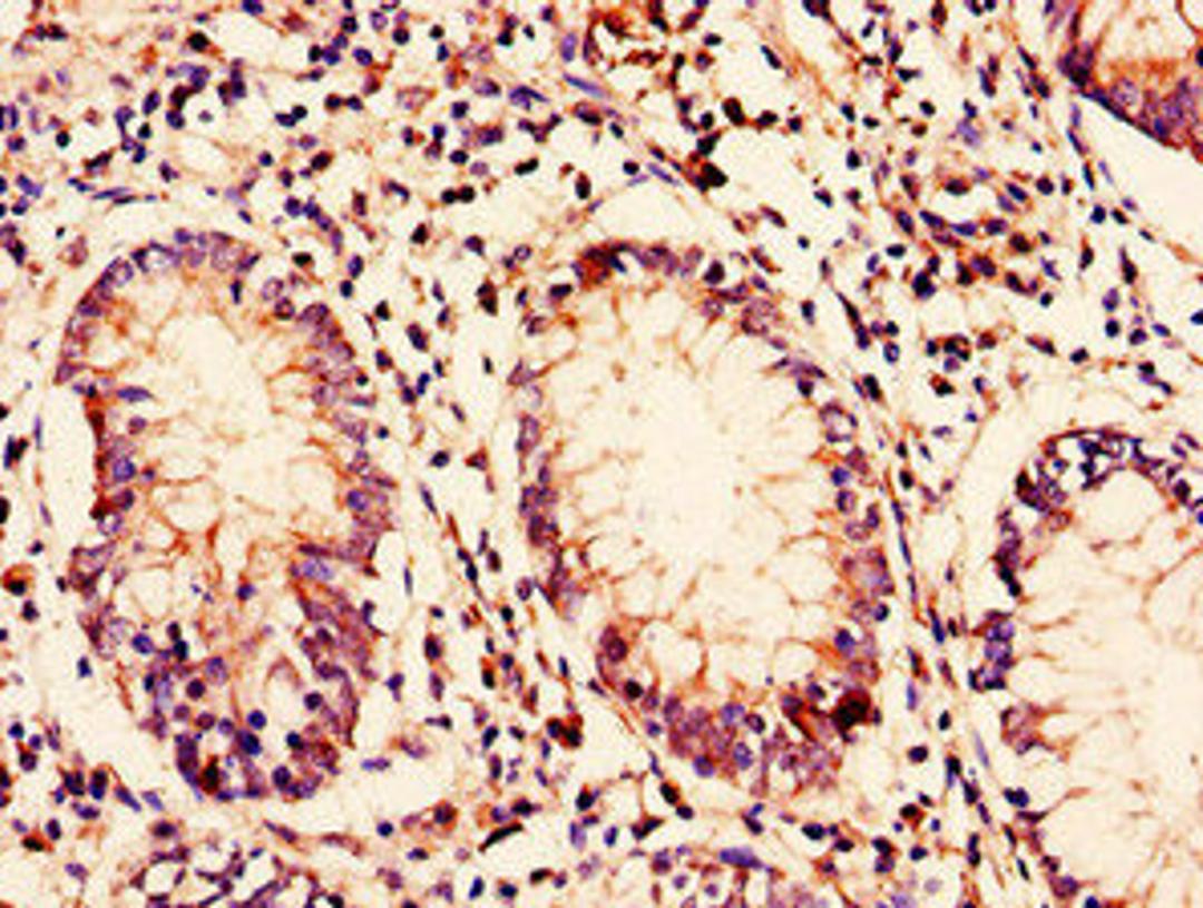 Immunohistochemistry of paraffin-embedded human colon cancer using CSB-PA842639LA01HU at dilution of 1:100