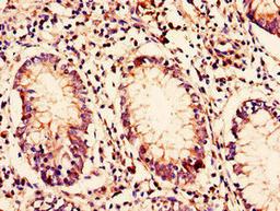 Immunohistochemistry of paraffin-embedded human colon cancer using CSB-PA842639LA01HU at dilution of 1:100