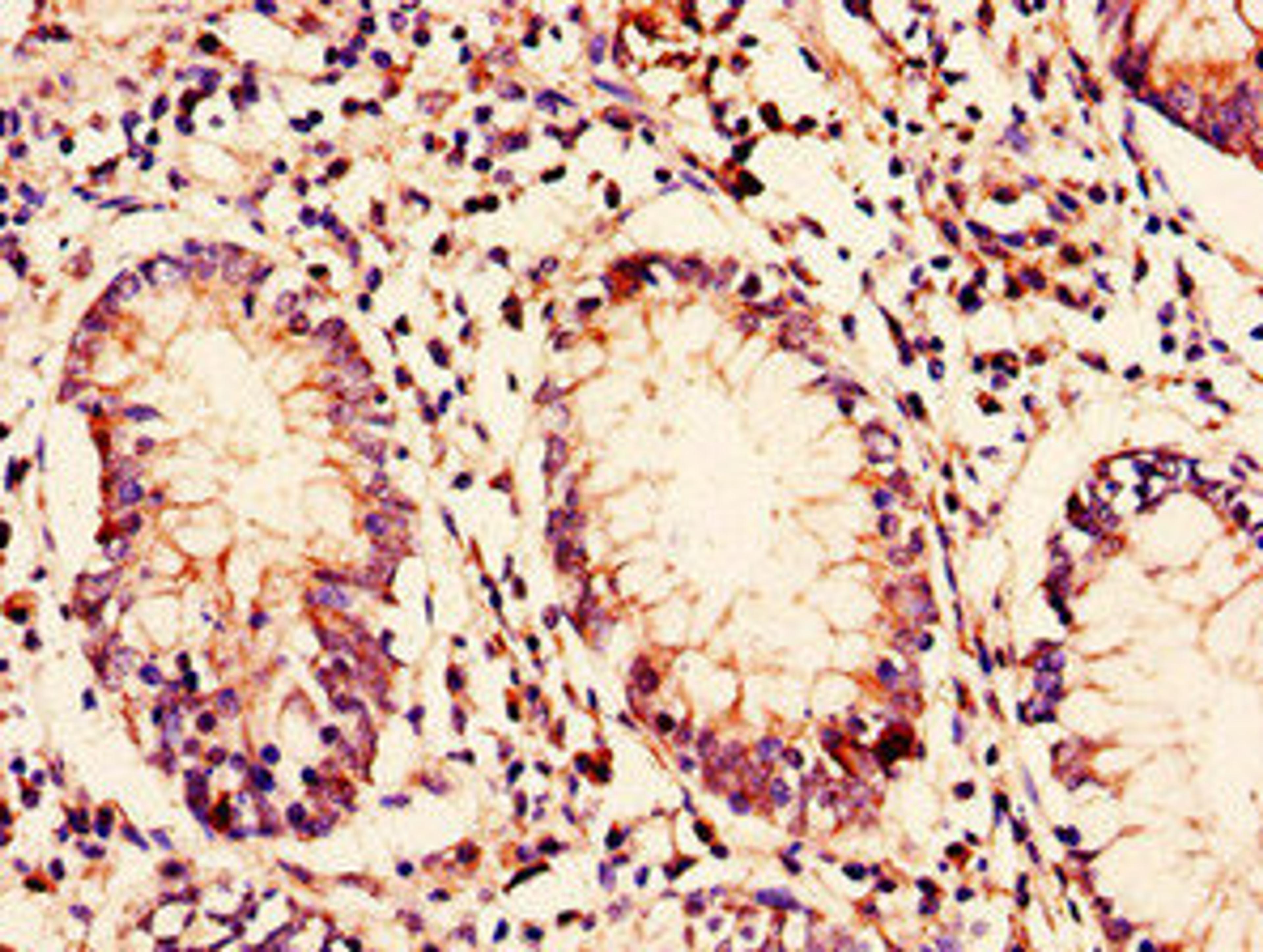 Immunohistochemistry of paraffin-embedded human colon cancer using CSB-PA842639LA01HU at dilution of 1:100
