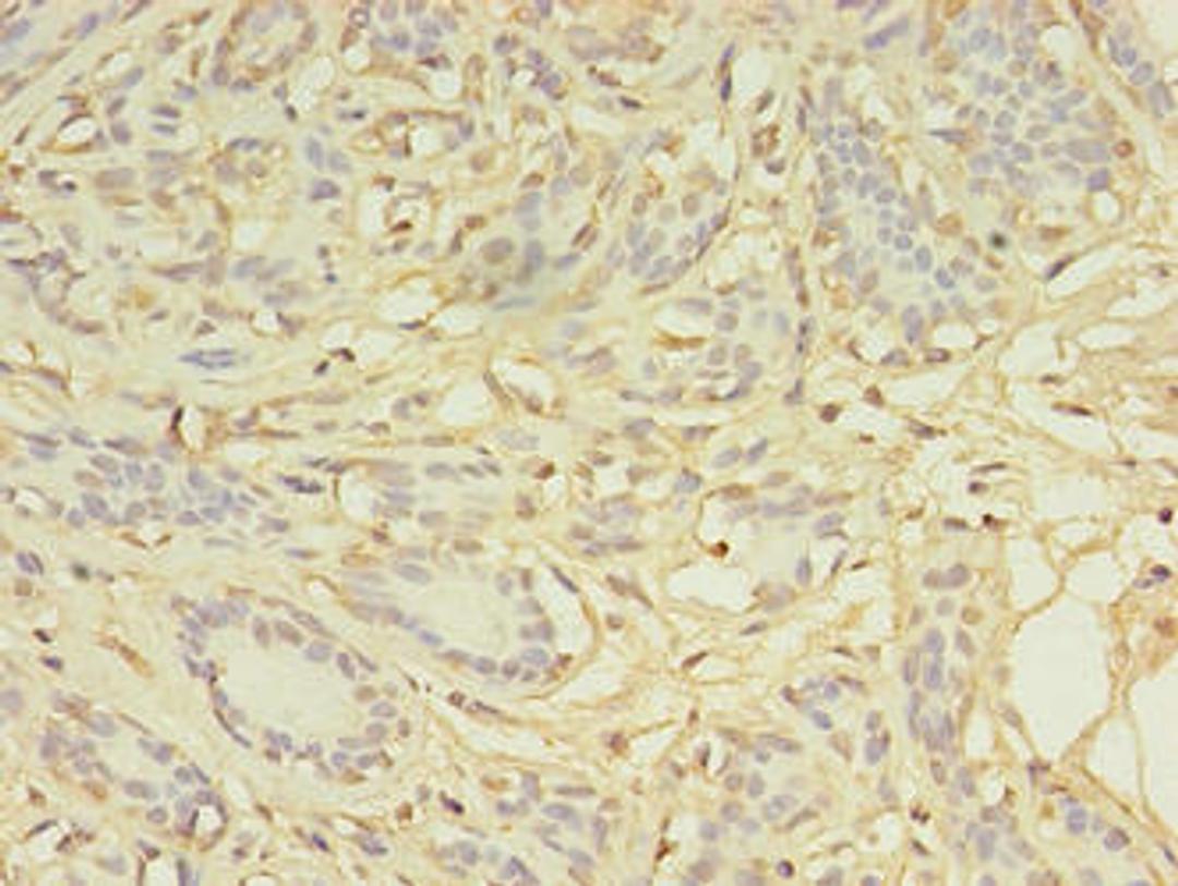 Immunohistochemistry of paraffin-embedded human breast cancer using CSB-PA732978LA01HU at dilution of 1:100