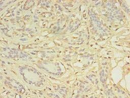 Immunohistochemistry of paraffin-embedded human breast cancer using CSB-PA732978LA01HU at dilution of 1:100