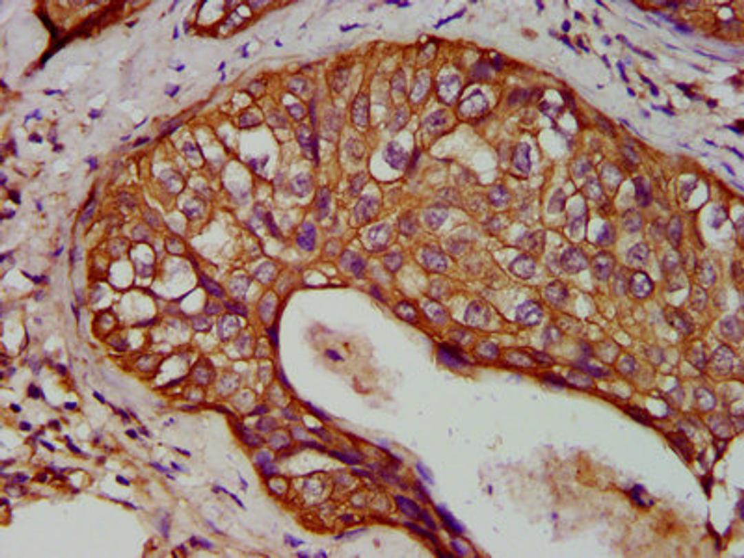 IHC image of CSB-PA012503LA01HU diluted at 1:400 and staining in paraffin-embedded human cervical cancer performed on a Leica BondTM system. After dewaxing and hydration, antigen retrieval was mediated by high pressure in a citrate buffer (pH 6.0). Section was blocked with 10% normal goat serum 30min at RT. Then primary antibody (1% BSA) was incubated at 4&deg;C overnight. The primary is detected by a biotinylated secondary antibody and visualized using an HRP conjugated SP system.